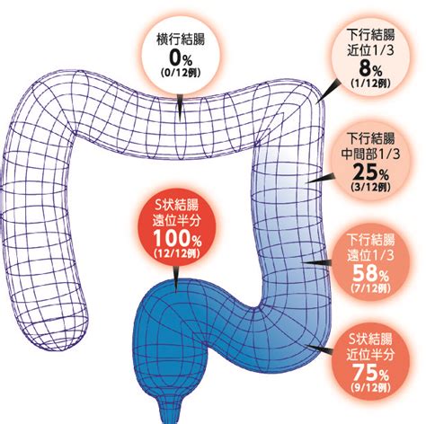 MtF / S字結腸 